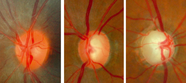 Glaucoma & Fields Test