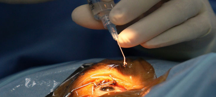 Sutureless Phaco Cataract Surgery